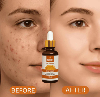 Best Organic Vitamin C Serum for Sensitive & Acne-Prone Skin(30ml)